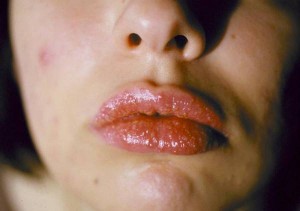 Bạn có thể bị dị ứng môi nghiêm trọng khi sử dụng son giả